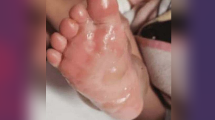Abuela quema los pies de su nieta de dos años con agua hirviendo