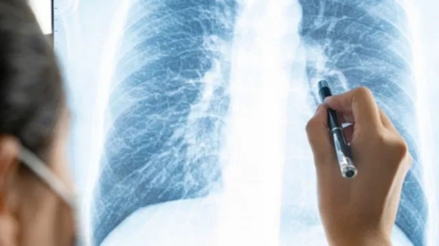 Realizan trasplante de pulmones a paciente Covid-19