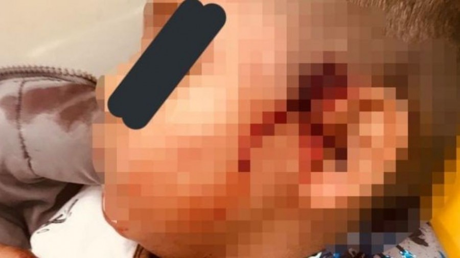 El menor herido por una bala perdida, se recupera del coma inducido