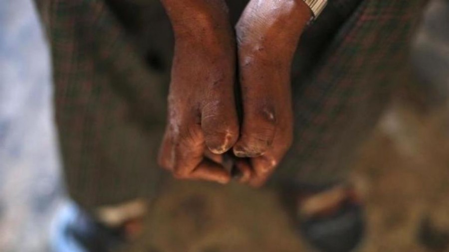 Reportan cinco casos de Lepra en México