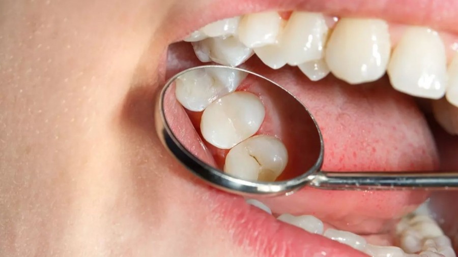 36.8 % de niños mexicanos tiene caries