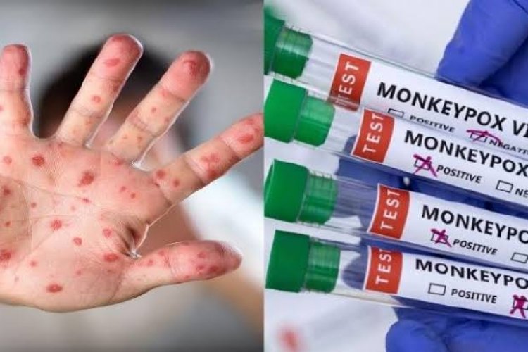 Aumentan casos de la viruela del mono en México; hay 5 confirmados