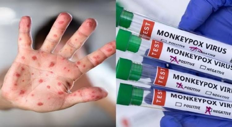 Aumentan casos de la viruela del mono en México; hay 5 confirmados