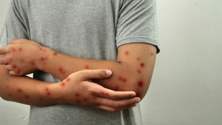 Suman 362 casos y una defunción por sarampión en México