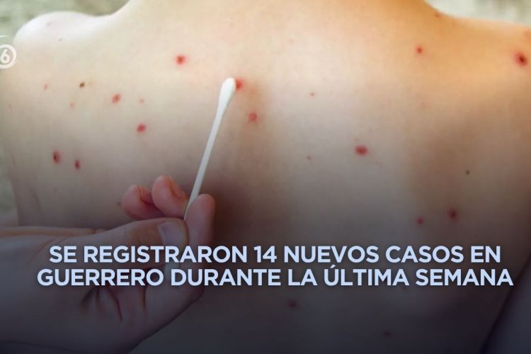 Guerrero se coloca en cuarto lugar nacional con más contagios de sarampión